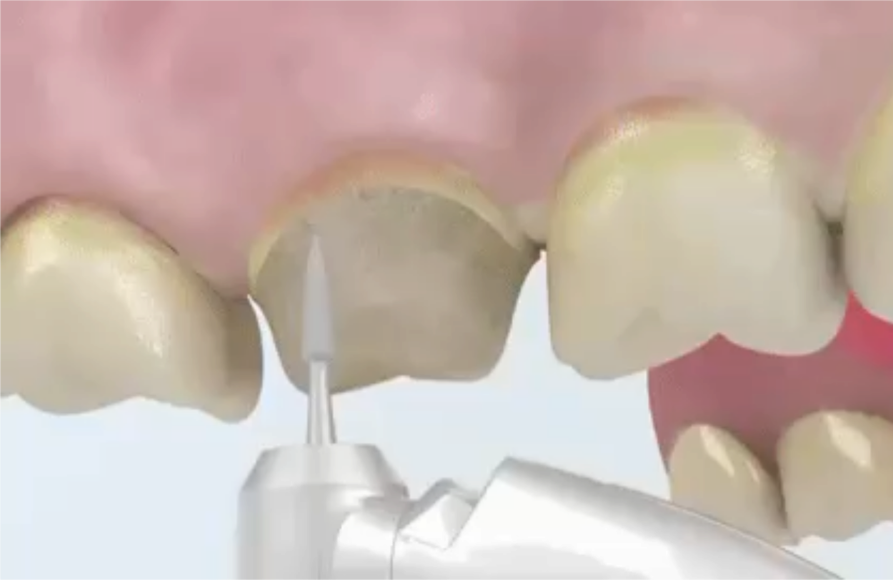 dental crown
