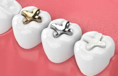 Dental implants in the mouth with dental fillings.