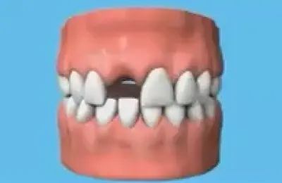 dental implant