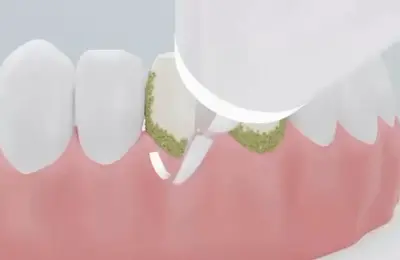 dental scaling
