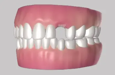 3D model of tooth with missing teeth, showing need for extraction treatment.