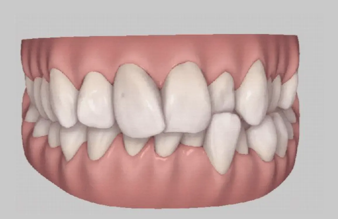 Orthodontic 3D tooth model with white teeth.