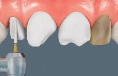 porcelain veneers