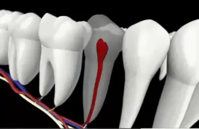 root canal extraction